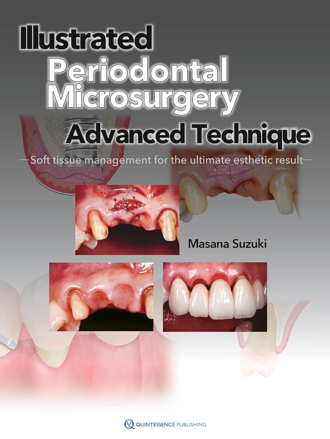 Illustrated advanced technique of periodontal microsurgery: soft tissue management for the ultimate esthetic result