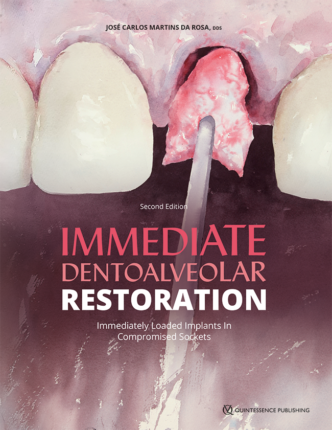 Immediate dentoalveolar restoration : immediately loaded implants in compromised sockets