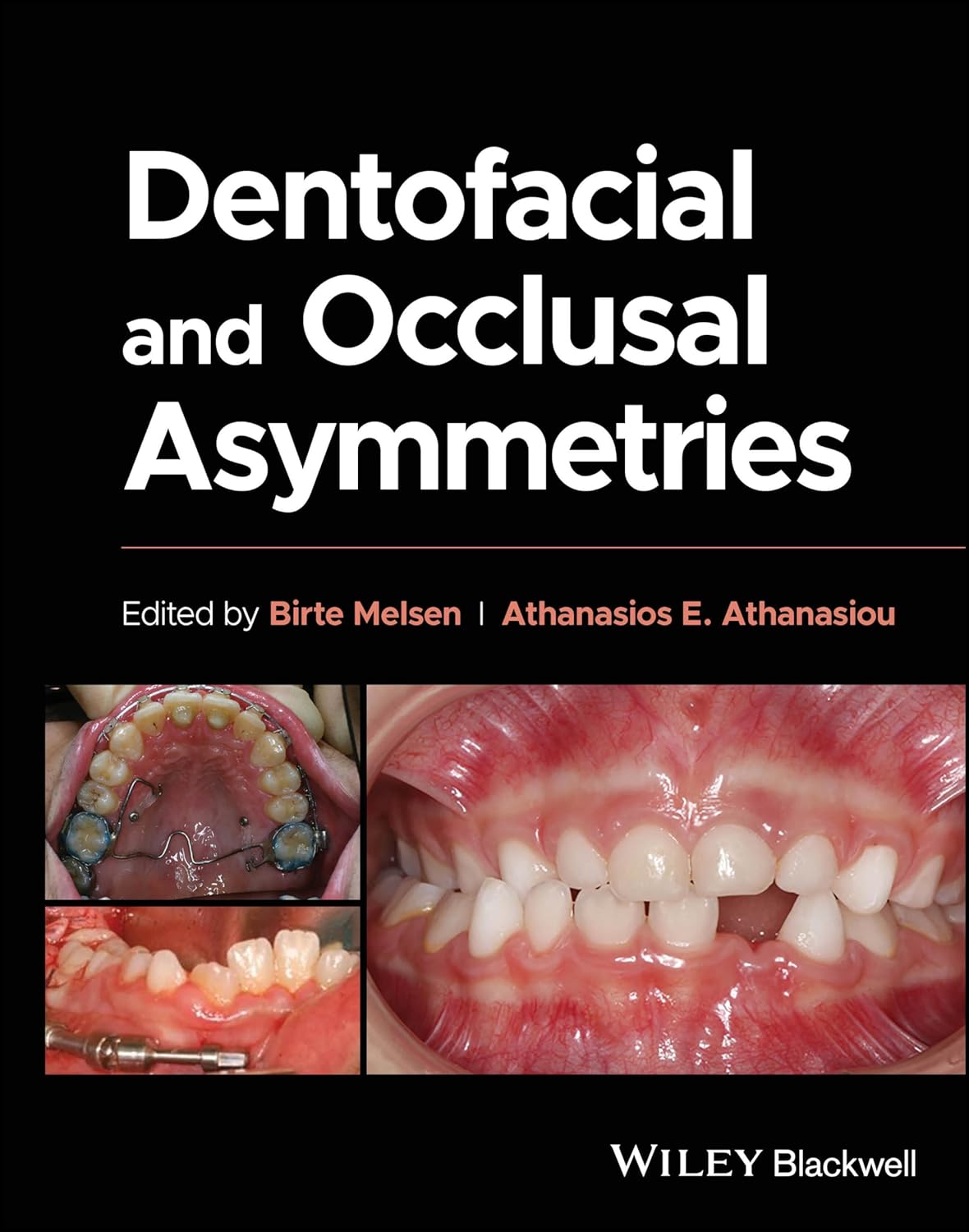 Dentofacial and occlusal asymmetries