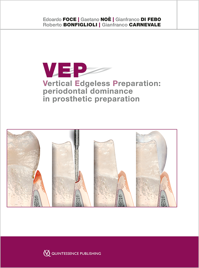 VEP Vertical Edgeless Preparation Periodontal dominance in prosthetic preparation