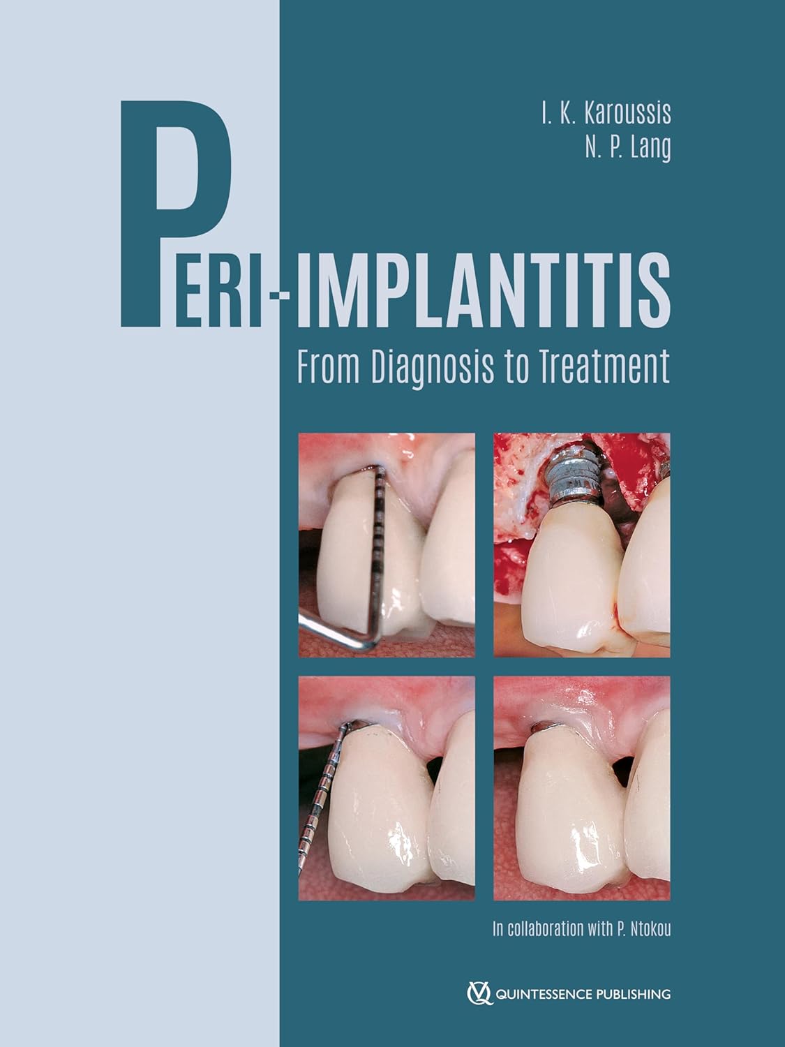 Peri-implantitis from diagnosis to treatment