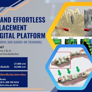 Accurate and Effortless Implant Placement Using A Digital Platform